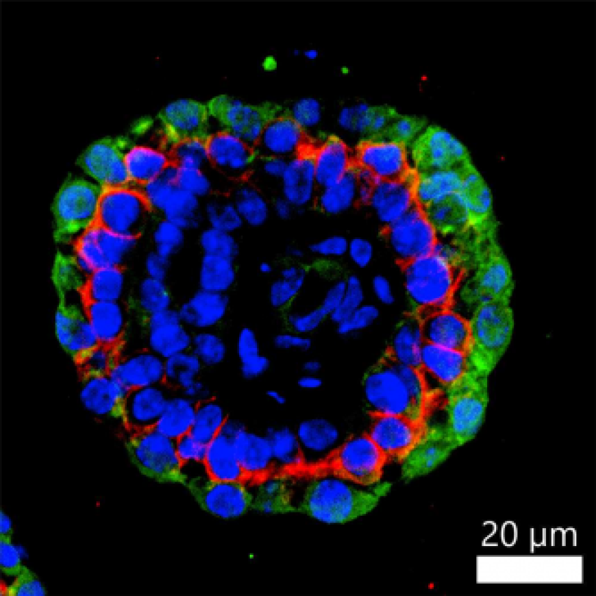 New Antibody-Drug Conjugate Shows Promise in Targeting Aggressive Triple-Negative Breast Cancer